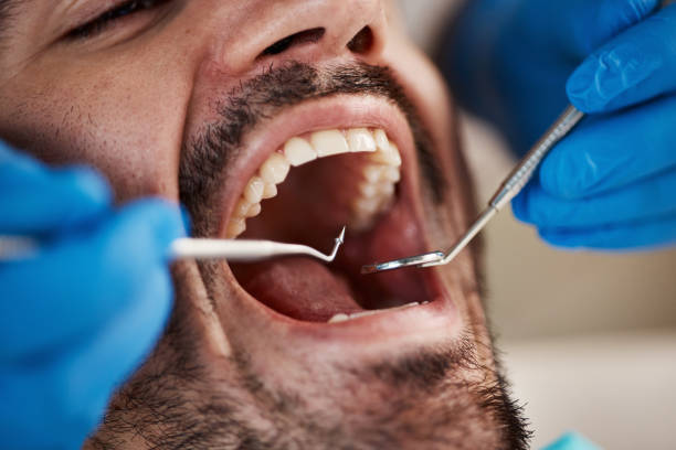 Best Emergency Wisdom Teeth Removal in Vine Grove, KY